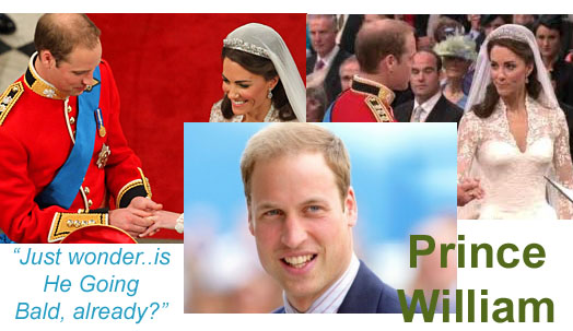 Prince William loosing his hair